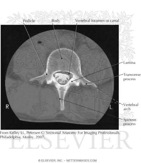 Axial CT Scan of Lumbar Vertebra