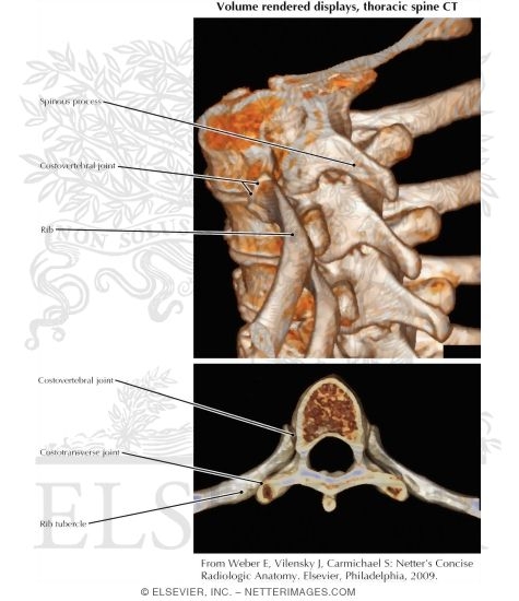 Costovertebral and Costotransverse Joints: Volume Rendered Displays, Thoracic Spine CT