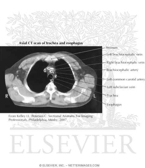 Axial CT Scan of Chest With Azygos and Hemiazygos Veins