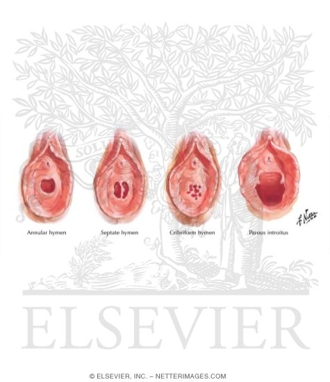 Variations In Hymen