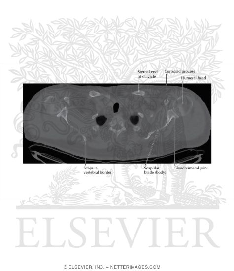 Watermarked preview of unlabeled image: Shoulder CT
