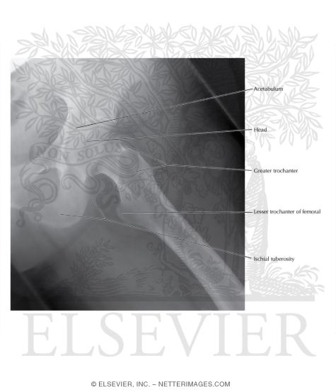 Lateral Hip: Radiograph