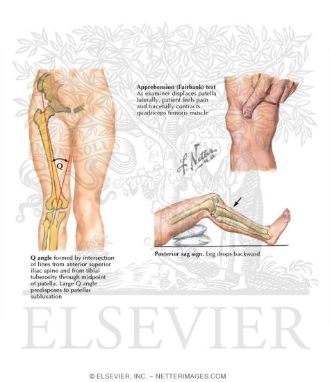 Watermarked preview of unlabeled image: Tests for Dislocation of Patella