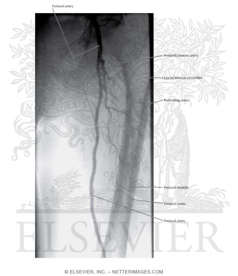 Femoral Arteriogram