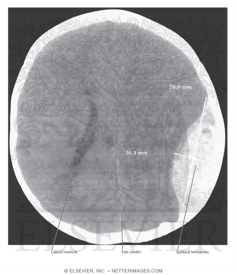 Watermarked preview of unlabeled image: CT of Brain Demonstrating Large Left Epidural Hematoma