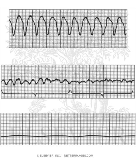Arrest Rhythms