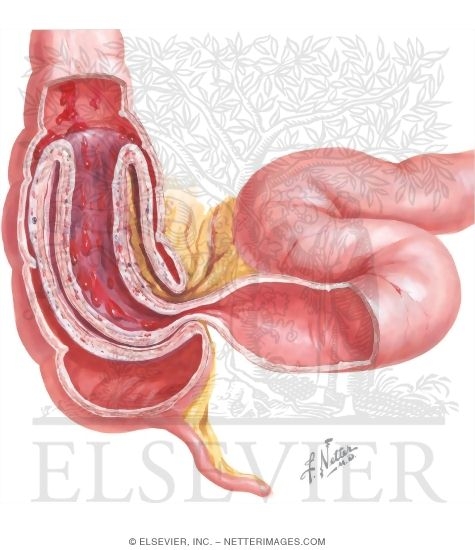 Intussusception