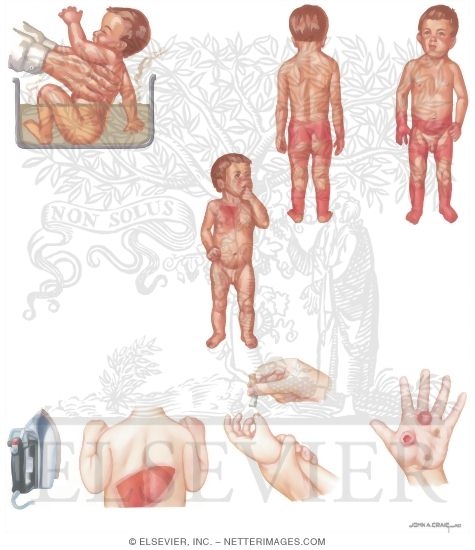 Child Abuse: Burn Injuries
