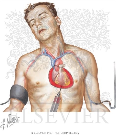 Watermarked preview of unlabeled image: Cardiac Tamponade and Pericardiocentesis