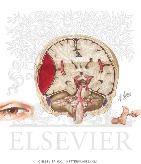 Epidural Hematoma
