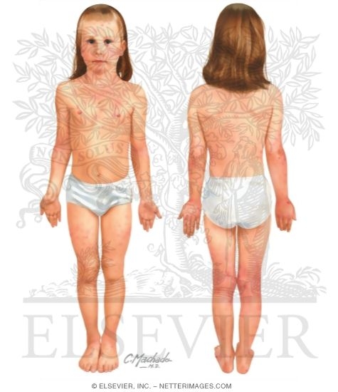Child With Atopic Dermatitis
