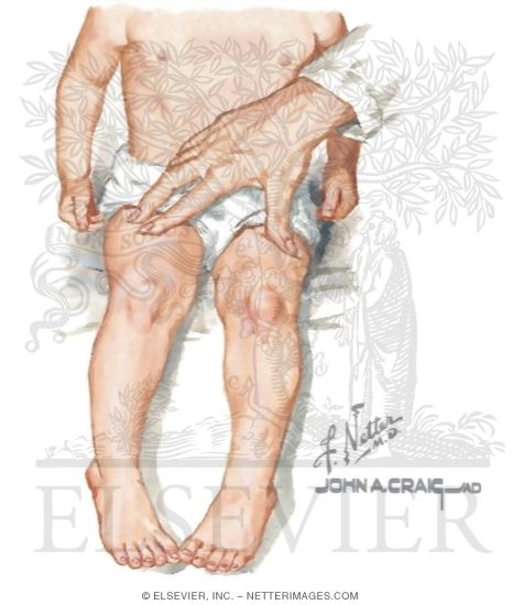 Internal Tibial Torsion