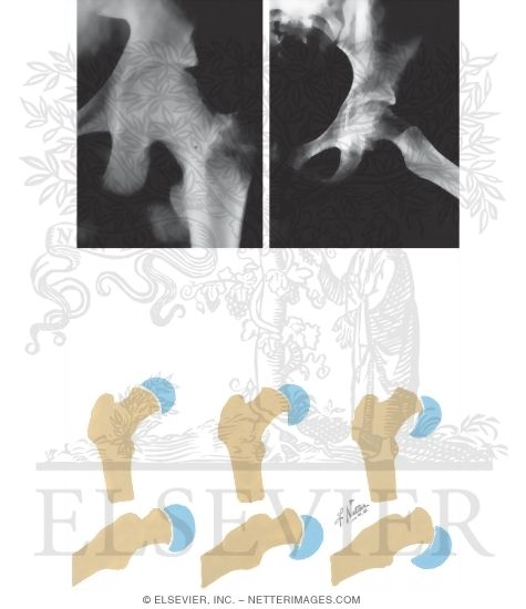 Slipped Capital Femoral Epiphysis