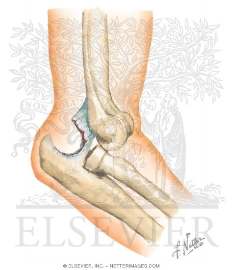 Elbow Dislocation