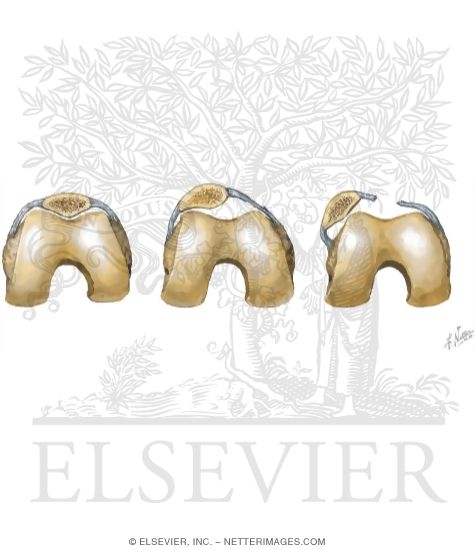 Watermarked preview of unlabeled image: Subluxation and Dislocation of Patella