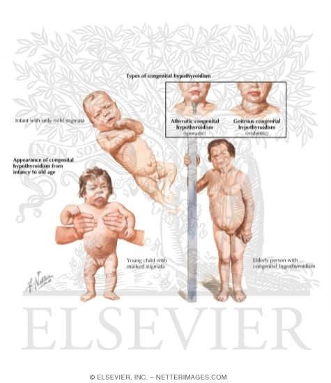 Watermarked preview of labeled image: Congenital Hypothyroidism