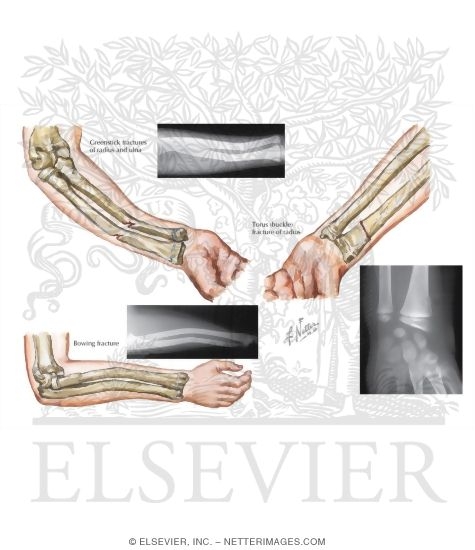 Incomplete Fracture in Children