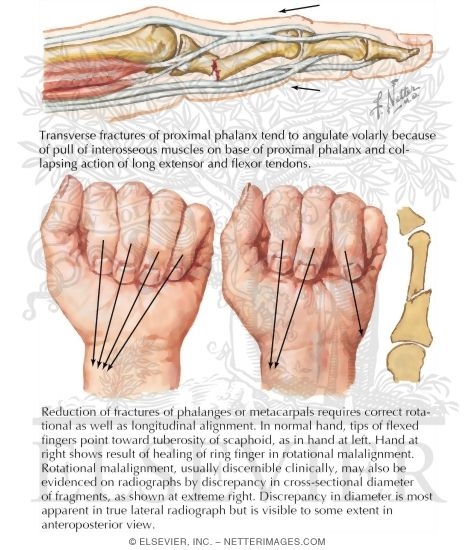 Watermarked preview of labeled image: Fracture of Proximal Phalynx