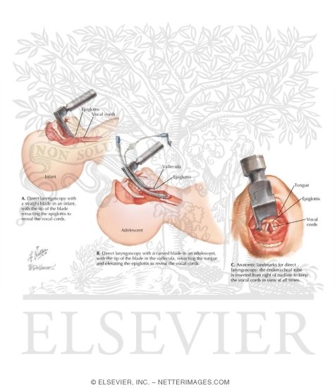Endotracheal Intubation
