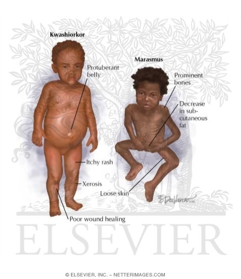 Malnutrition