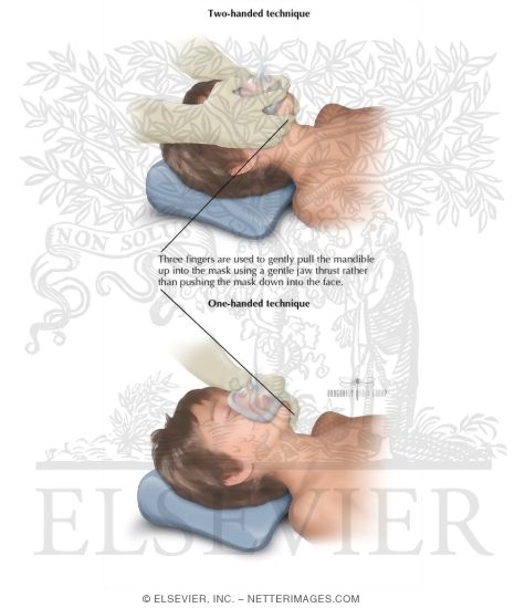 Maintaining Airway Patency and Securing the Mask In Bag-Valve-Mask Ventilation