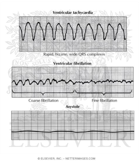 Arrest Rhythms
