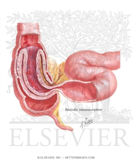 Watermarked preview of labeled image: Intussusception