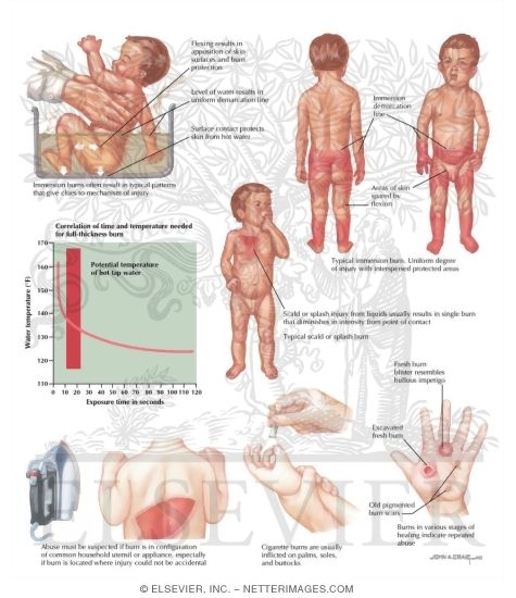 Child Abuse: Burn Injuries