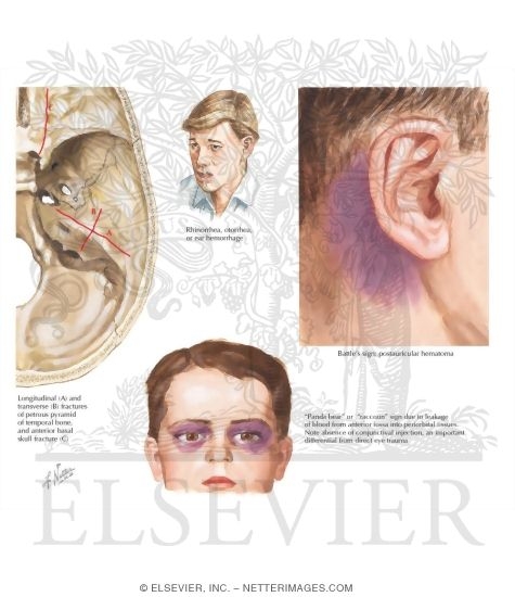 Basilar Skull Fracture: Physical Findings