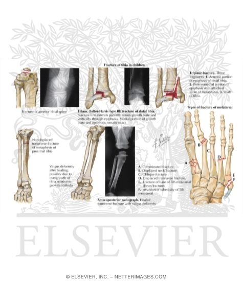 Fractures of the Ankle and Foot