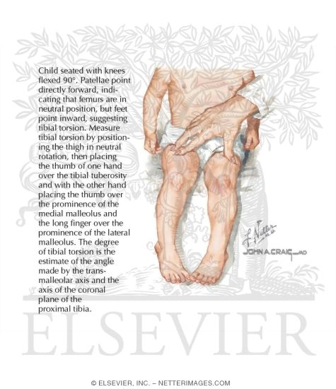 Internal Tibial Torsion