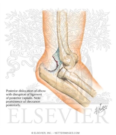 Elbow Dislocation