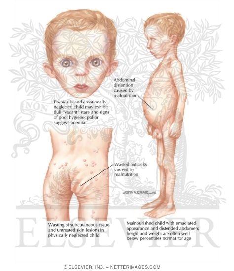 Child Abuse: Signs Of Neglect