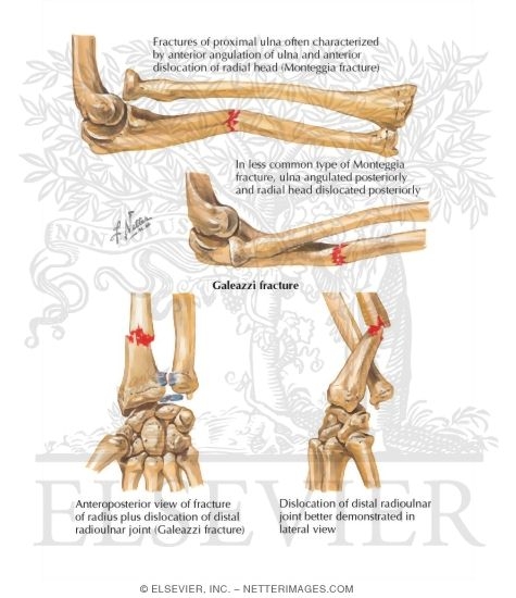 Monteggia Fracture
Galeazzi Fracture