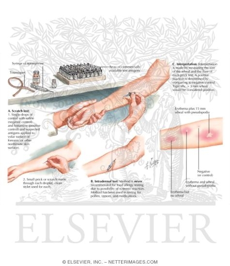 Watermarked preview of labeled image: Skin Testing for Allergy