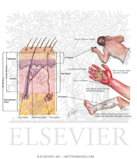 Classification of Burns