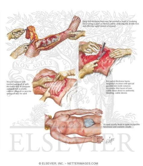 Watermarked preview of labeled image: Excision and Grafting for Burns