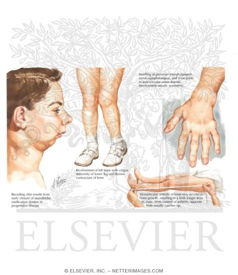 Watermarked preview of labeled image: Clinical Signs of Oligoarticular and Polyarticular Juvenile Idiopathic Arthritis
