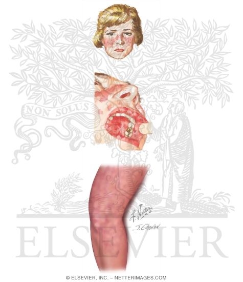 Skin and Mucus Membrane Manifestations of Systemic Lupus Erythematosus