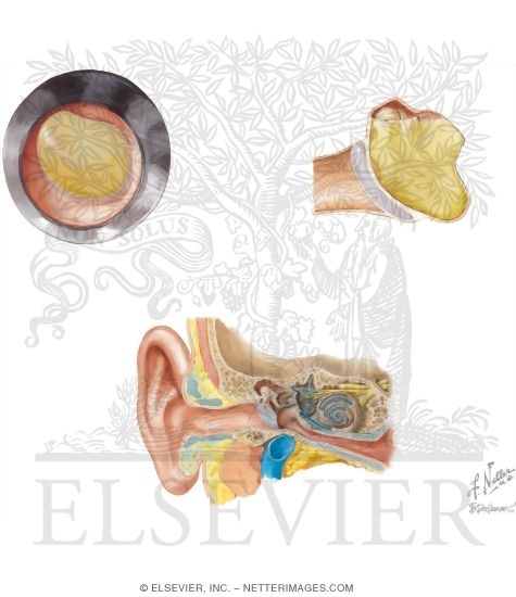 Acute Otitis Media