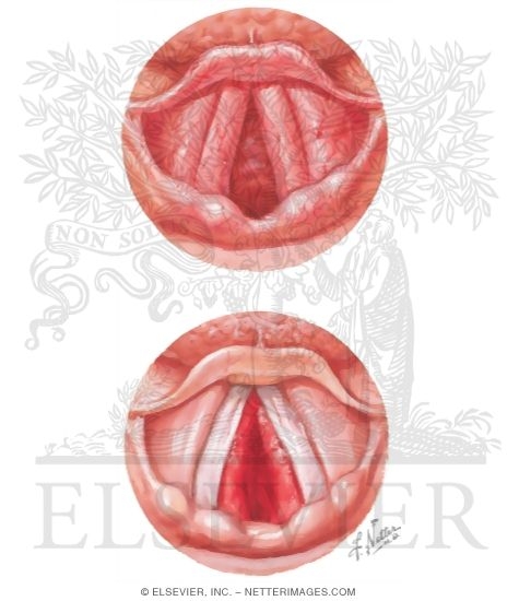 Croup