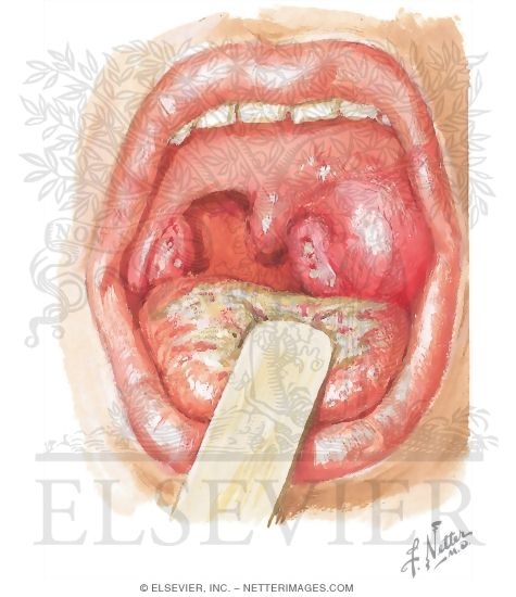 Peritonsillar Abscess