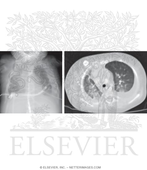 Pleural Effusion
