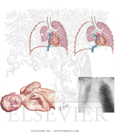 Watermarked preview of unlabeled image: Tension Pneumothorax