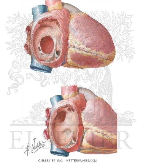 Defects of the Atrial Septum