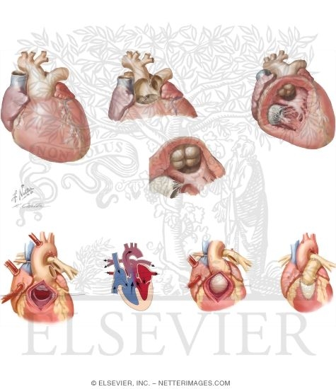 Truncus Arteriosus Communis