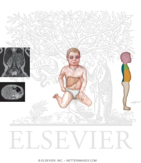 Summary of Clinical Presentation of Nueroblastoma