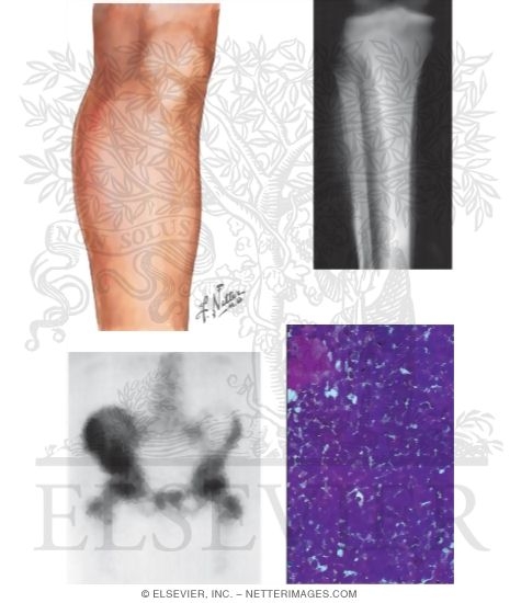 Ewing's Sarcoma