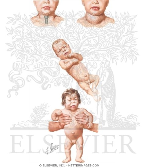 Watermarked preview of unlabeled image: Congenital Hypothyroidism