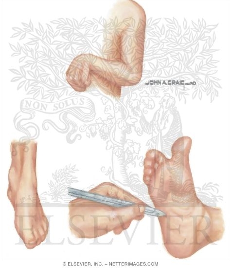 Characteristic Pattern In Spastic Limbs
